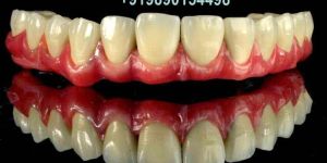 Dental Implant Surgery