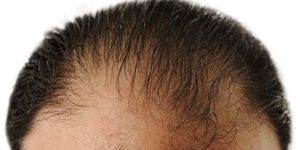 Hair Transplant Service
