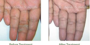 Homeopathy Medicine For Psoriasis - HomeoConsult