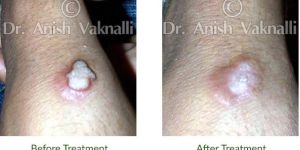 Homeopathy Treatment for Warts - HomeoConsult