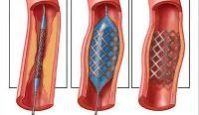Coronary Stents
