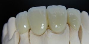 Dental Ceramic Bridges