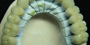 Dental Ceramic Laminations