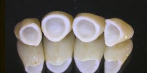 Dental Crowns