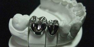 Metal Ceramic Crowns