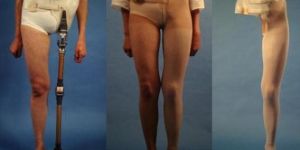 Hip Disarticulation Prosthesis