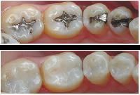 Dental Fillings