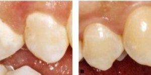 Early Caries Detection Tests