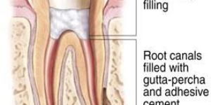 Root Canal Sealing
