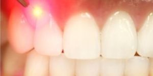 Laser Dentistry