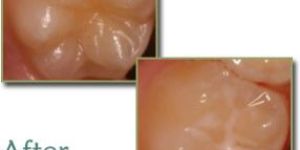 Pit And Fissure Sealants