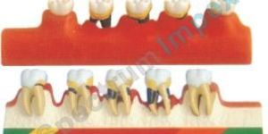 Periodontal Disease Model