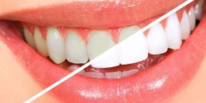 Aesthetic Filling Services