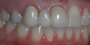 Dental Crowns and Bridges