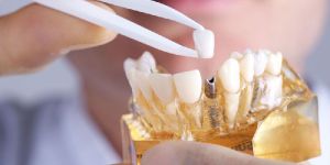 Dental Implant Services