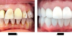 Full Mouth Rehabilitation