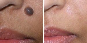 Mole Removal Services