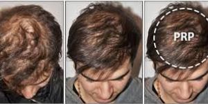 Prp Hair Therapy