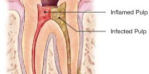 Root Canal Treatment