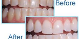 Teeth Whitening Services