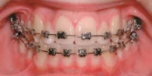 Tooth Braces