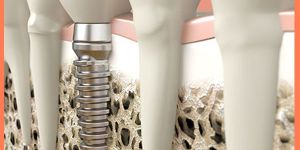 Bone Grafting