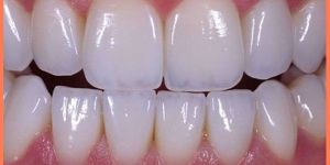 CAD-CAM Zirconia Crown