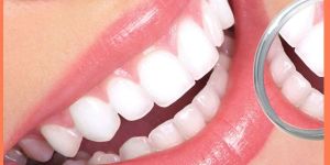 Dental Bleaching