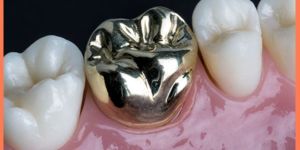 Dental Metal Crown