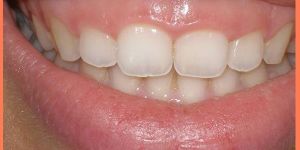 Gummy Smile Correction