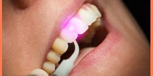 Laser Gum Treatment