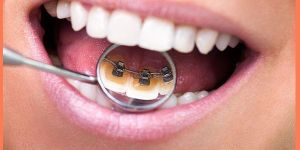 Lingual Braces