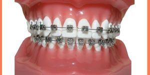 Metal Braces