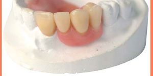 Partial Dentures (Removale)