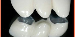 Porcellin (PFM) Crown