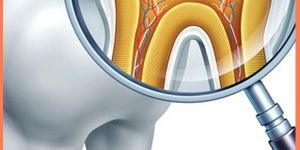 Re Root Canal Treatment