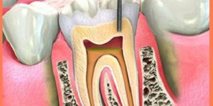 Root Canal Treatment (Rct)