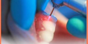 Root Canal Treatment with Laser
