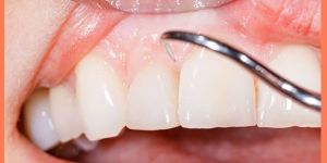 Salling Dental Cleaning