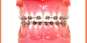 Self Ligating Cosmetic Braces