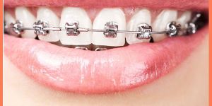 Self Ligating Metal Braces