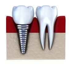 Titanium Dental Implant