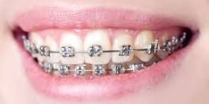 Dental Brace