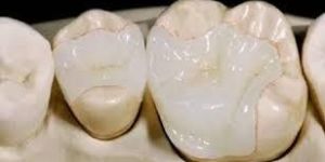 Dental Filling Material