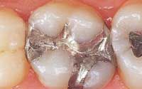 Dental Fillings