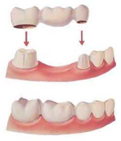 Dental Bridge