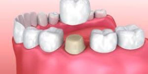 Dental Crowns
