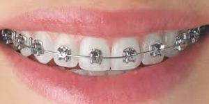 Dental Brace