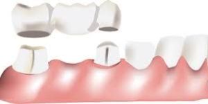 Dental Bridge