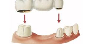 Dental Crowns